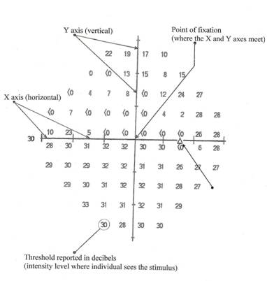 HFA 30-2 dB printout for the right eye, showing X and Y axis,
      point of fixation, normal blind spot, threshold in decibels