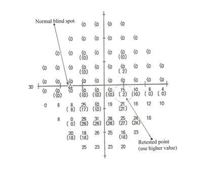 HFA 30-2 dB printout for the left eye, showing X and Y axis,
      normal blind spot, and retested point