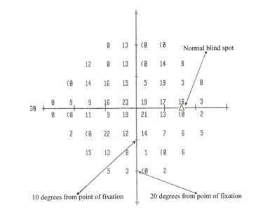 HFA 24-2 dB printout for the right eye, showing X and Y axis,
      10 degrees from point of fixation, 20 degrees from point of fixation