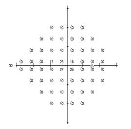 HFA 24-2 dB printout for the right eye