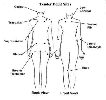 illustration of tender point sites, back view and front view